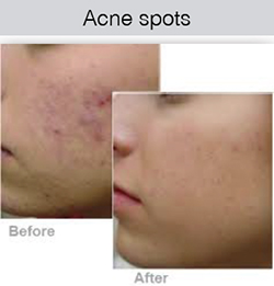 ipl-acne