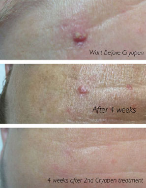 cryopen-treatment-15
